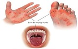 [ẢNH] Những loại bệnh dịch phổ biến do thời tiết ở Việt Nam